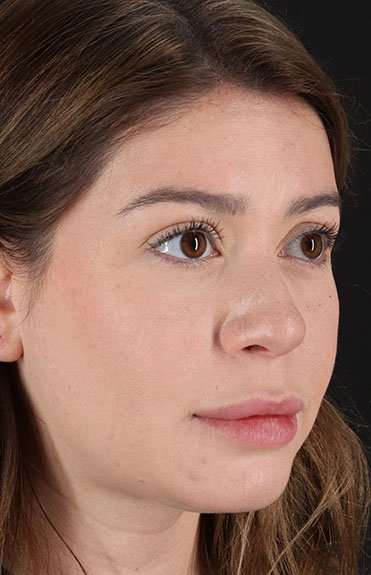 Liquid Rhinoplasty Before & After Patient #2210