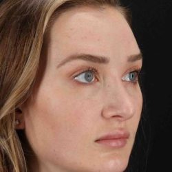 Browlift Before & After Patient #1297