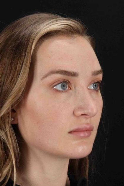 Browlift Before & After Patient #1297