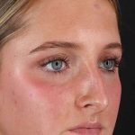 Liquid Rhinoplasty Before & After Patient #2221