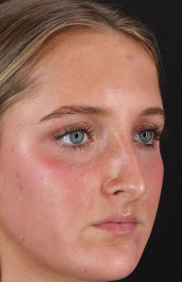 Liquid Rhinoplasty Before & After Patient #2221