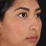 Liquid Rhinoplasty Before & After Patient #2232