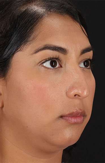 Liquid Rhinoplasty Before & After Patient #2232