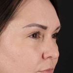 Liquid Rhinoplasty Before & After Patient #2243