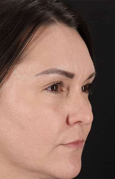 Liquid Rhinoplasty Before & After Patient #2243