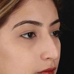 Liquid Rhinoplasty Before & After Patient #2254