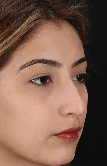 Liquid Rhinoplasty Before & After Patient #2254