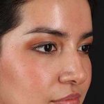 Liquid Rhinoplasty Before & After Patient #2265