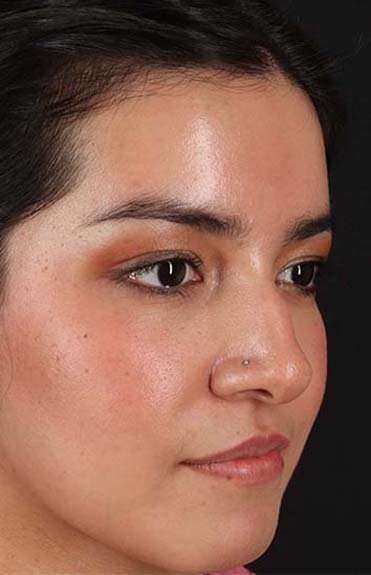 Liquid Rhinoplasty Before & After Patient #2265