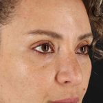 Liquid Rhinoplasty Before & After Patient #2276