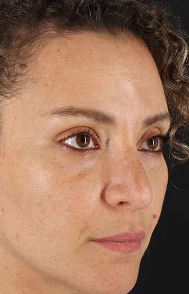 Liquid Rhinoplasty Before & After Patient #2276