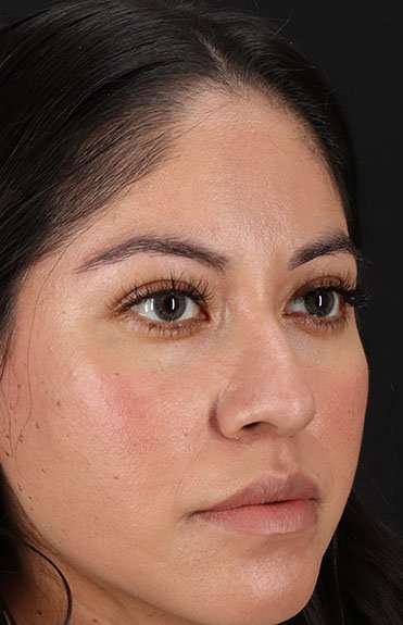 Liquid Rhinoplasty Before & After Patient #2290