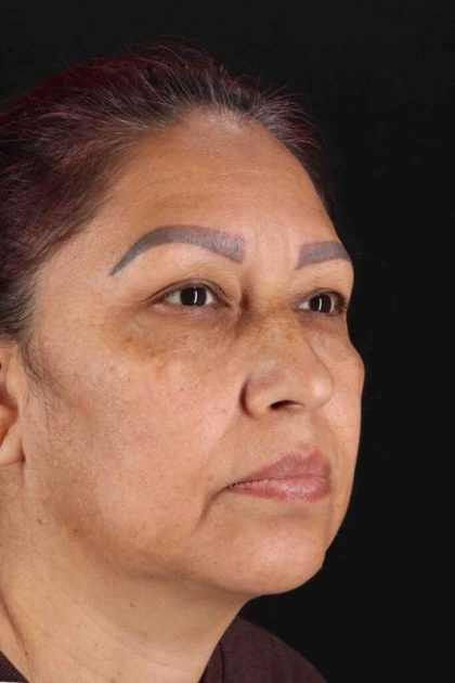 Lower Blepharoplasty Before & After Patient #2321