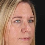 Lower Blepharoplasty Before & After Patient #2376