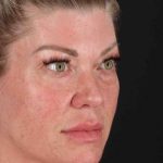 Lower Blepharoplasty Before & After Patient #2387