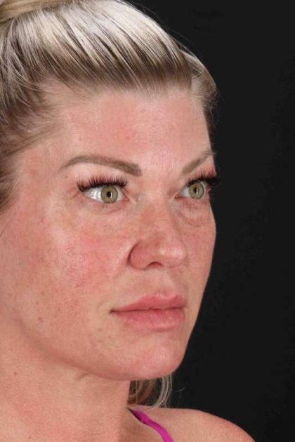 Lower Blepharoplasty Before & After Patient #2387