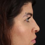 Browlift Before & After Patient #1220