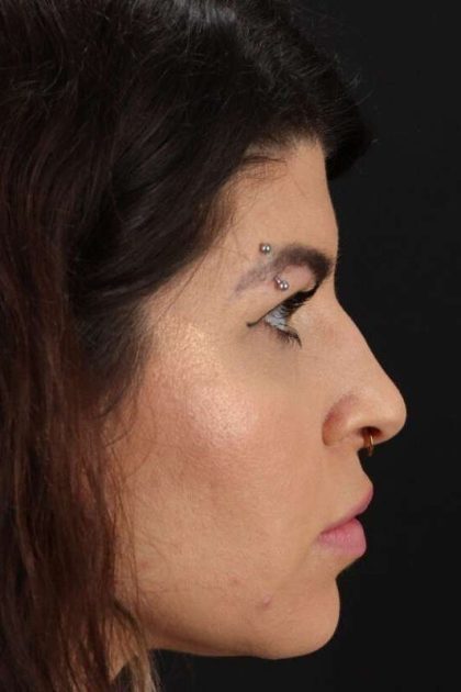 Browlift Before & After Patient #1220