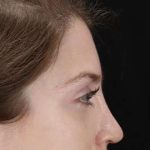 Browlift Before & After Patient #1319