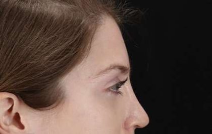 Browlift Before & After Patient #1319