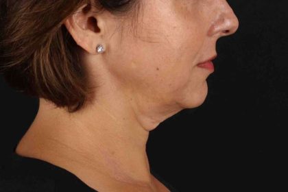 Neck Lift Before & After Patient #2472