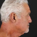 Neck Lift Before & After Patient #2483