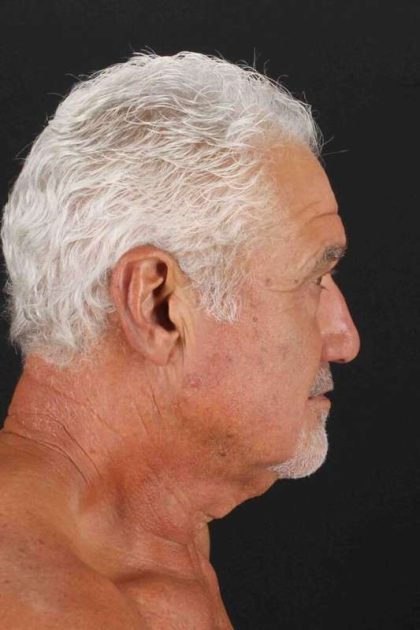 Neck Lift Before & After Patient #2483