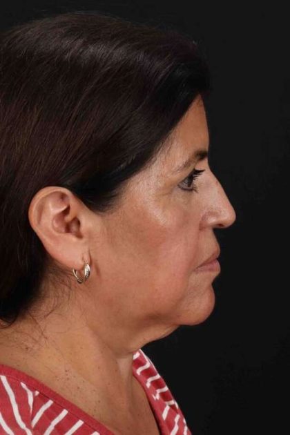 Neck Lift Before & After Patient #2516