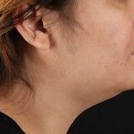 Neck Lift Before & After Patient #2560