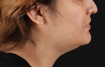 Neck Lift Before & After Patient #2560