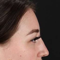 Browlift Before & After Patient #1330