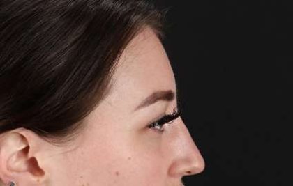 Browlift Before & After Patient #1330