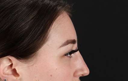 Browlift Before & After Patient #1330