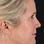 Neck Lift Before & After Patient #2582