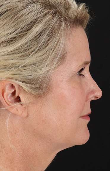 Neck Lift Before & After Patient #2582