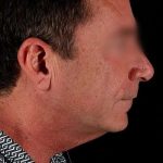 Neck Lift Before & After Patient #2604