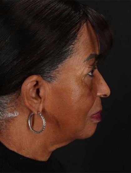 Neck Lift Before & After Patient #2615