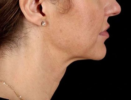 Neck Lift Before & After Patient #2626