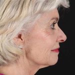 Neck Lift Before & After Patient #2637