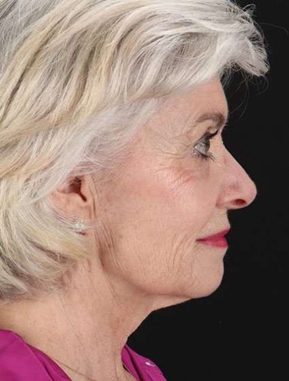 Neck Lift Before & After Patient #2637