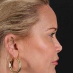 Neck Lift Before & After Patient #2659