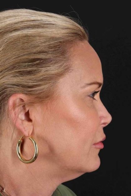 Neck Lift Before & After Patient #2659