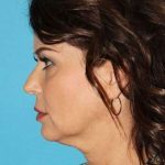 Neck Lift Before & After Patient #2699