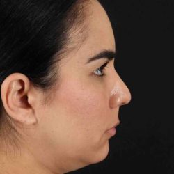 Browlift Before & After Patient #1341
