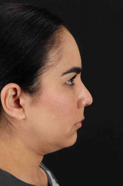 Browlift Before & After Patient #1341