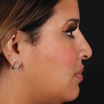Neck Liposuction Before & After Patient #2708