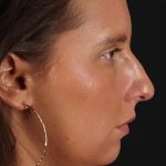 Neck Liposuction Before & After Patient #2719