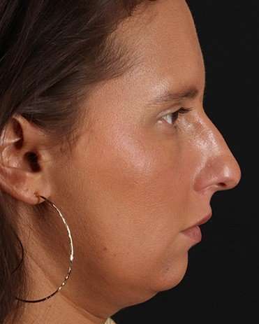 Neck Liposuction Before & After Patient #2719