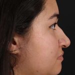 Neck Liposuction Before & After Patient #2730