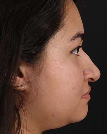 Neck Liposuction Before & After Patient #2730